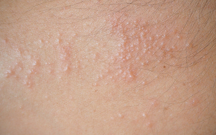 Doctor explains HEAT RASH (miliaria) in a baby  Causes, symptoms,  treatment and prevention 