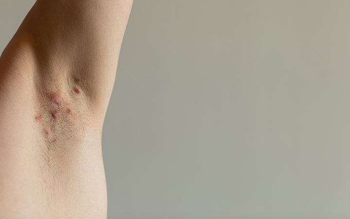 Most Common Causes & Treatments For Armpit Pimples – Vedix