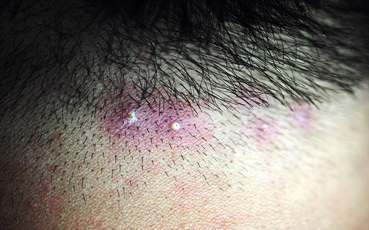 inflamed hair follicle on shaft