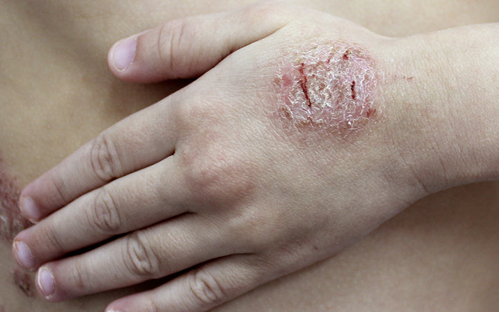 nummular dermatitis in child