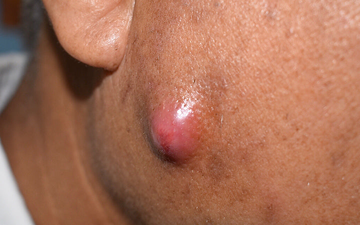 painful large cystic acne on cheeks