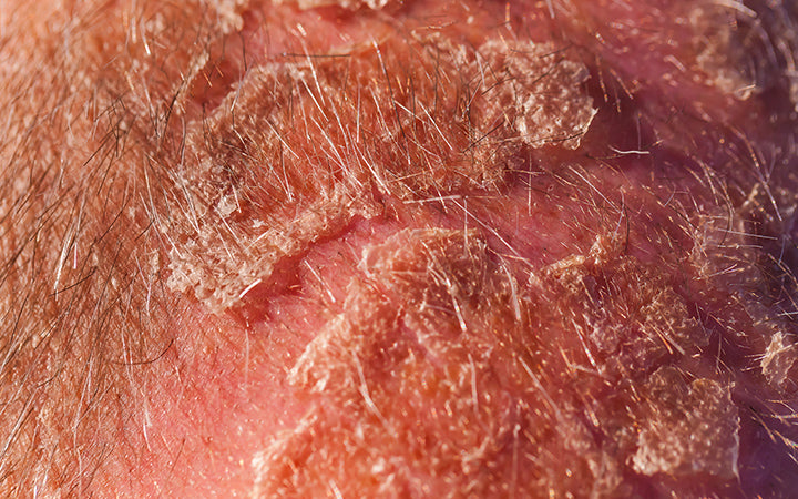 Scalp Eczema