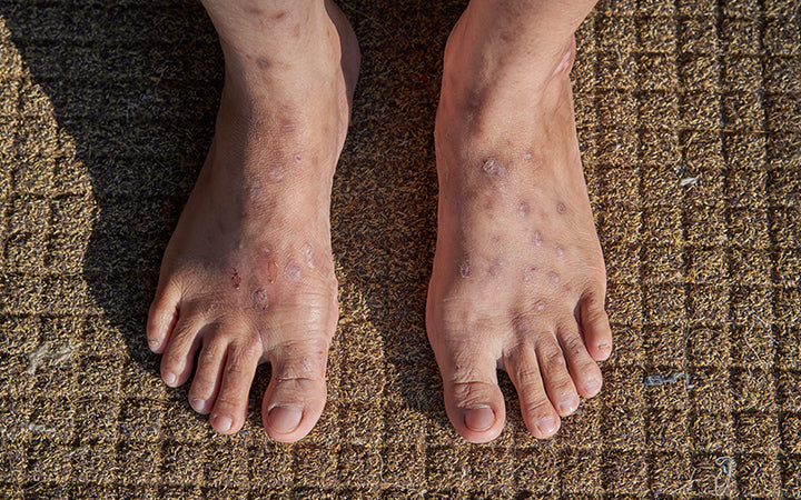 scars on feet statis dermatitis