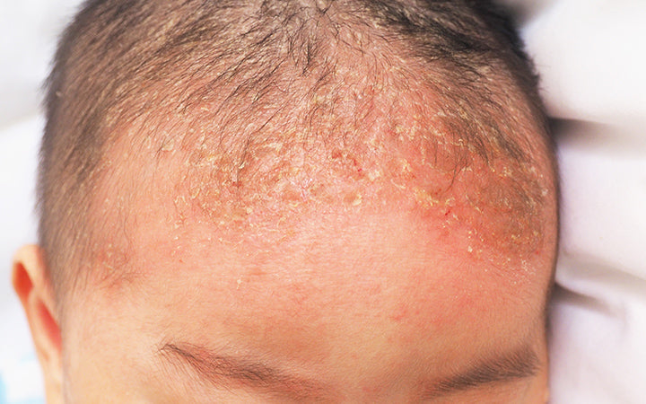 seborrheic dermatitis in baby