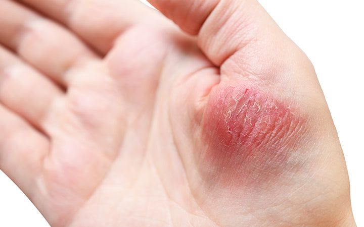 skin inflammation on hand