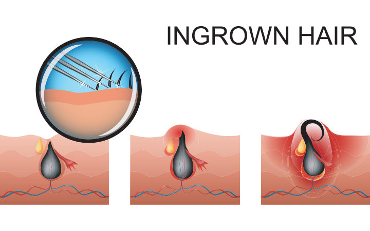 Ingrown Hair Cysts Treatments Causes  Symptoms  Starpil Wax