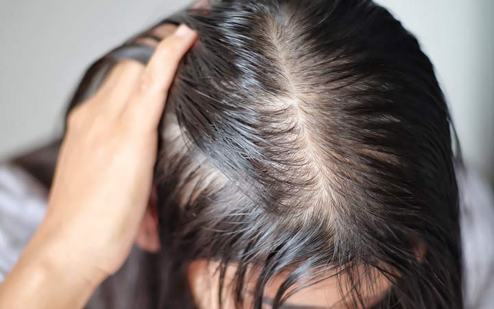 Effective ways to manage top 5 types of hair problems  Derma Essentia