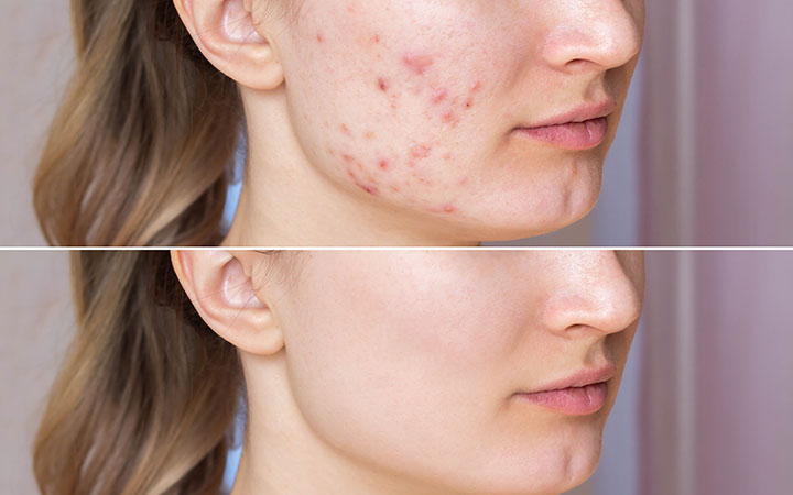 woman's face before and after acne treatment