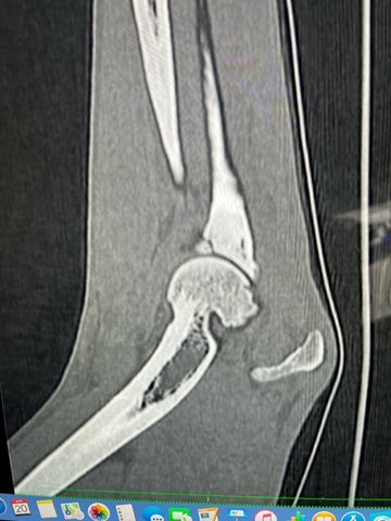 The X-Ray showing the fragmented bone