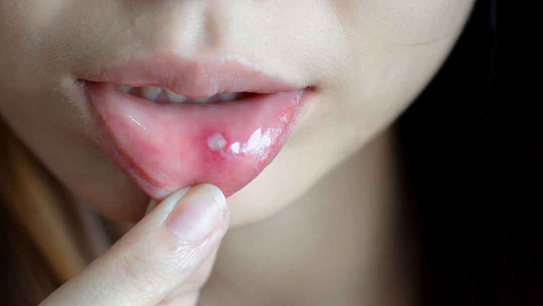 Canker Sore Cure 12 Home Remedies And When To See A Doctor The Amino