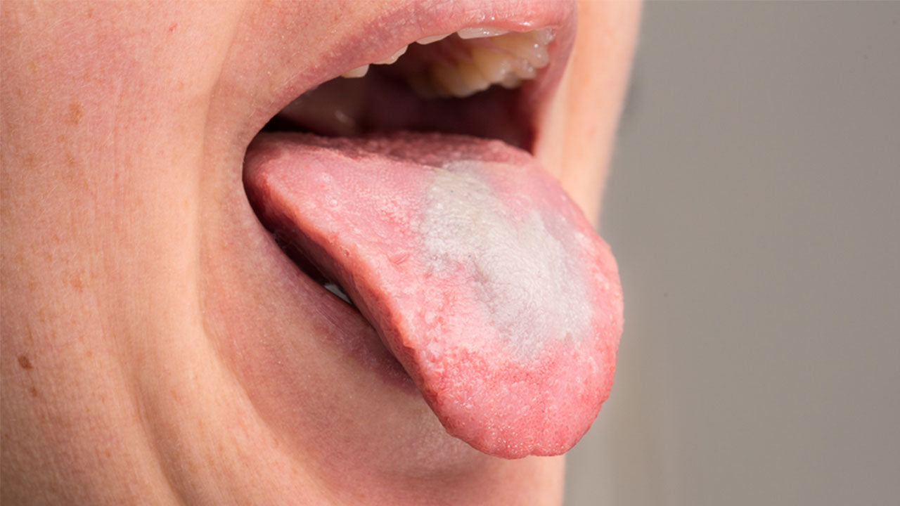 How to Treat Oral Thrush: Beware of These Symptoms!