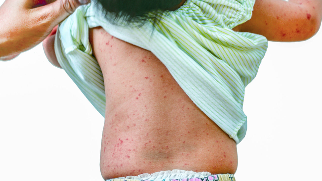 roseola-rash-sixth-disease-in-children-and-adults-the-amino-company