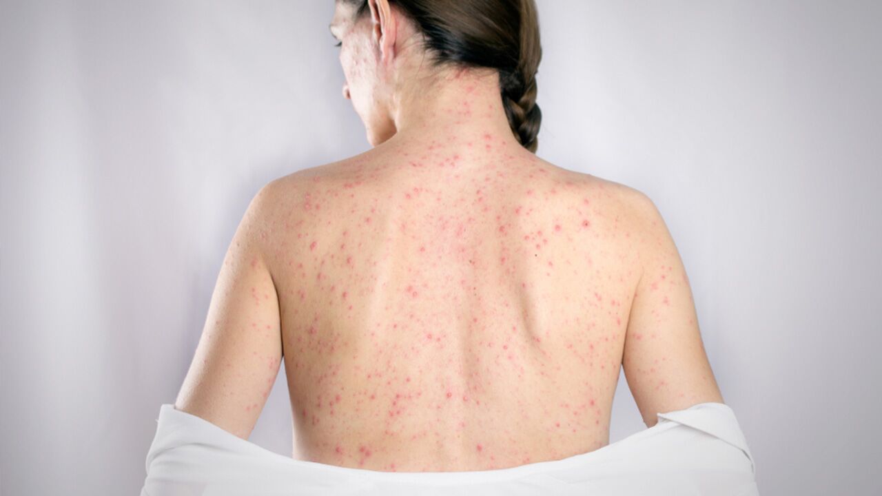 How To Spot Measles Symptoms Understand The Cause Treatment The Amino Company 