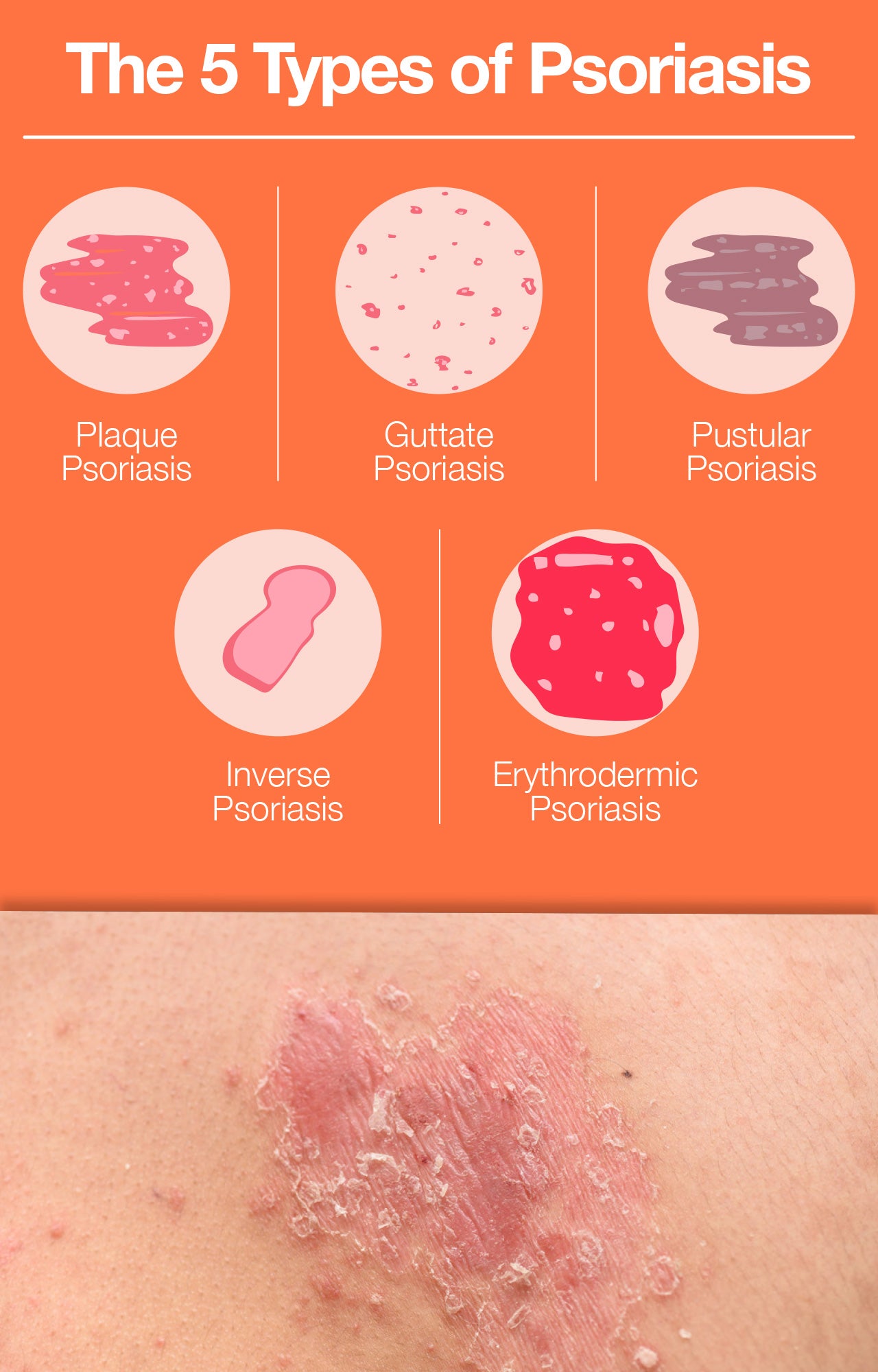 What Is Psoriasis Learn About Causes Symptoms Treatments The Amino Company 