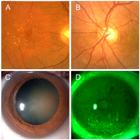 Representative images of ocular conditions that may benefit from the use of astaxanthin: age-related macular degeneration (Panel A), glaucoma (Panel B), cataract (Panel C), keratopathy due to dry eye (Panel D) 