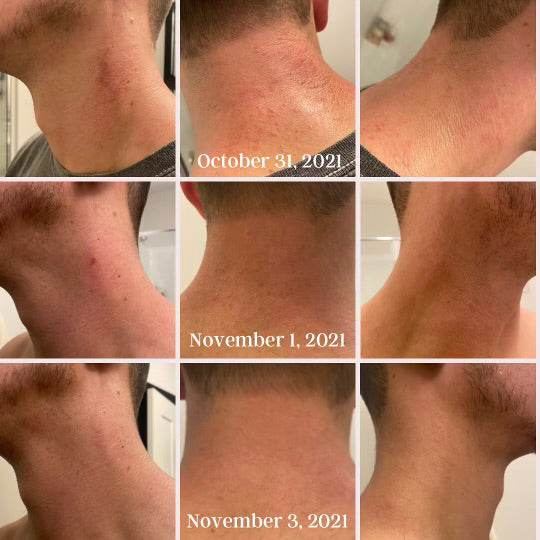 Qet-Botanicals-Before-and-After-Rash-Sensitive-Skin