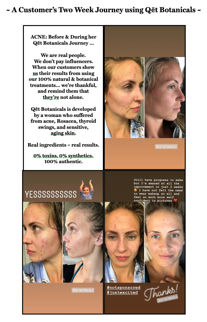 Qet-Botanicals-Before-and-After-Acne-Breakouts-Uneven-Complexion