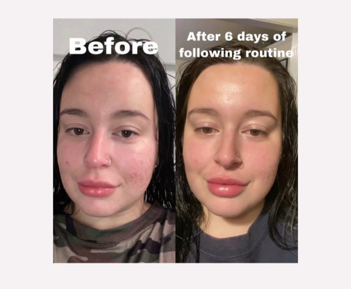 Qet-Botanicals-Before-and-After-Acne-Sensitive-Bumpy-Skin