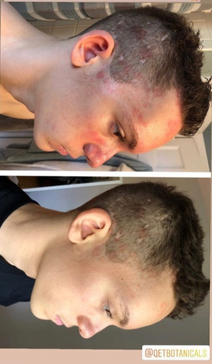 Qet-Botanicals-Before-and-After-Eczema-Psoriasis-on-Scalp