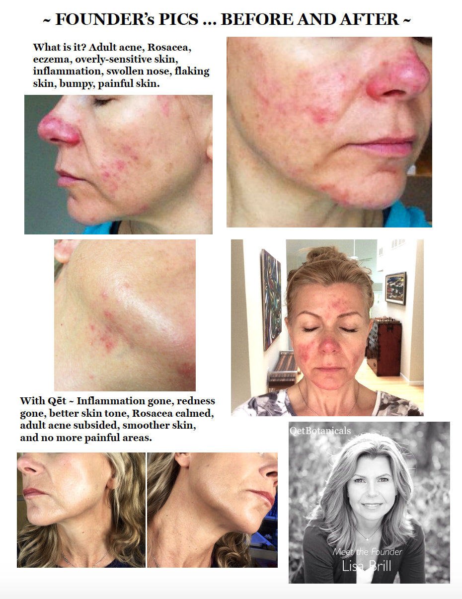 Qet-Botanicals-Founder-Before-and-After-Rosacea-Sensitive-Inflammation