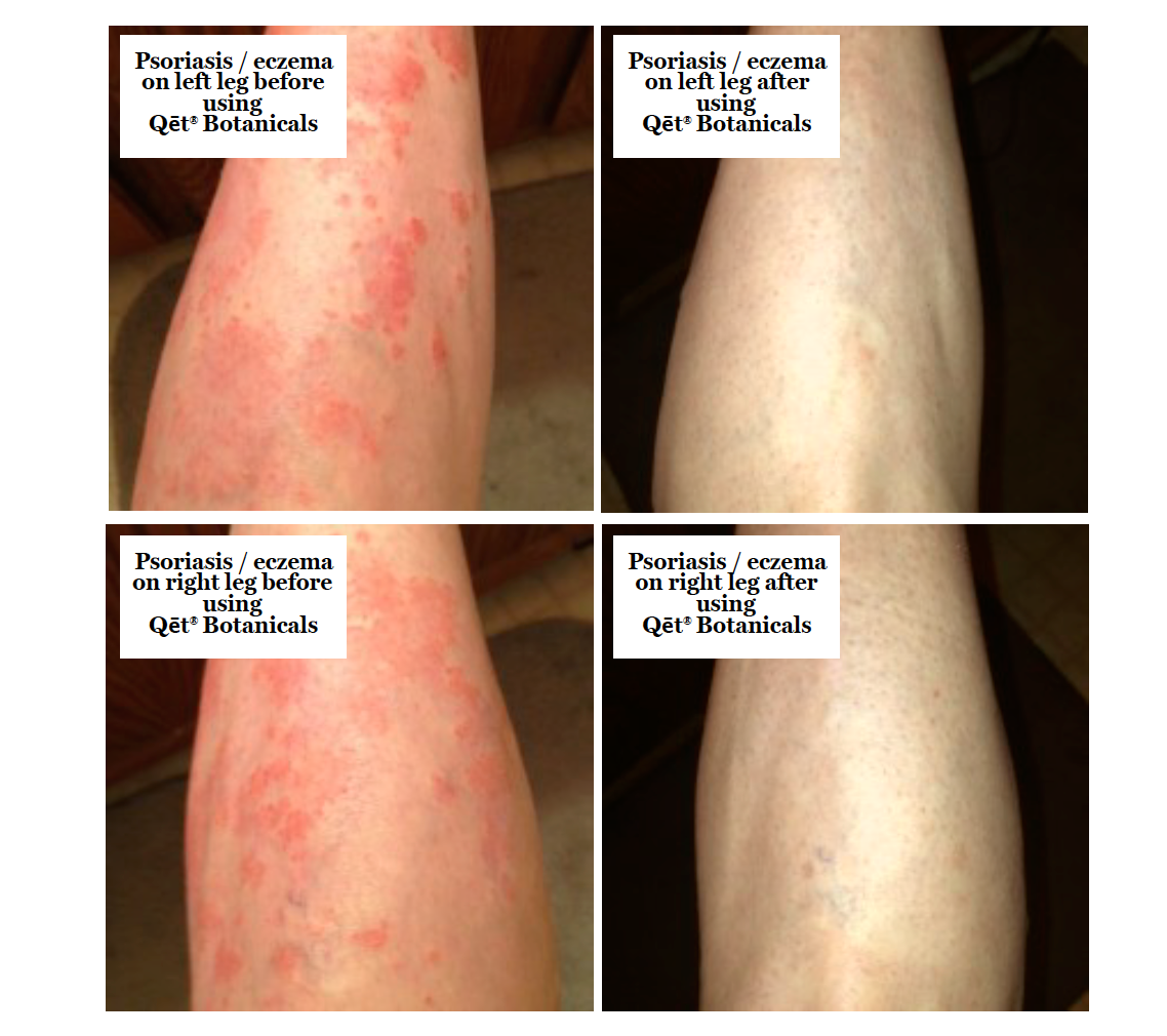 Qet-Botanicals-Before-and-After-Eczema-Psoriasis-Sensitive-Skin