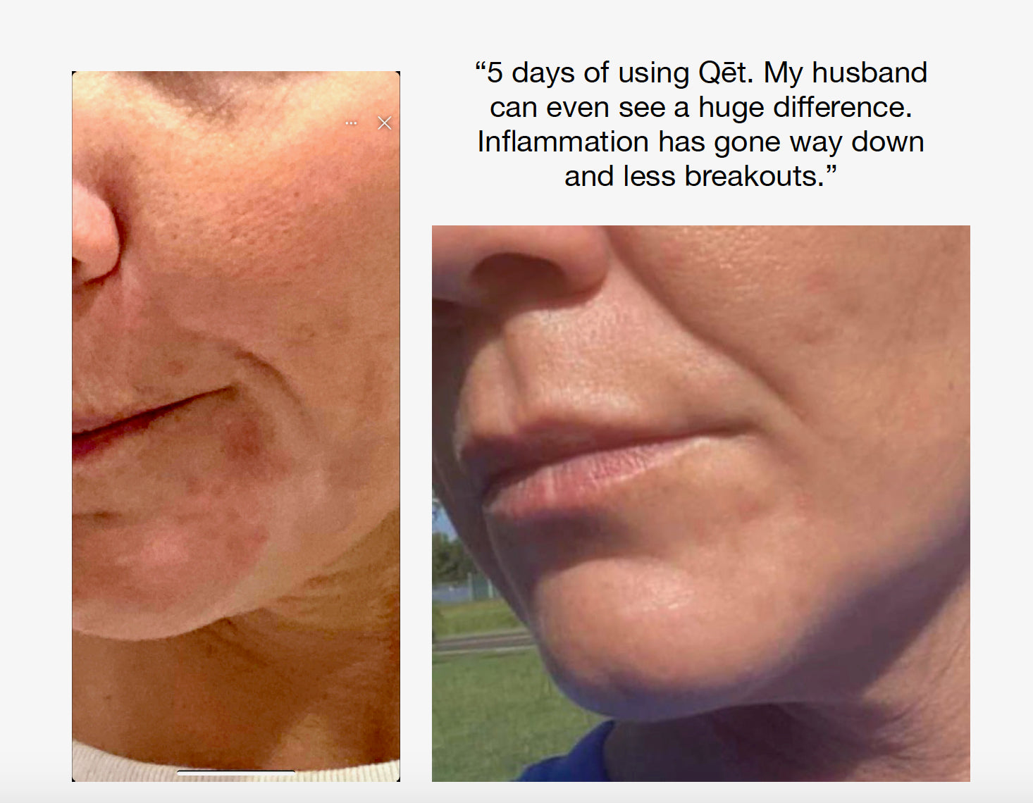 Qet-Botanicals-Before-and-After-Maskne-Hormonal-Acne
