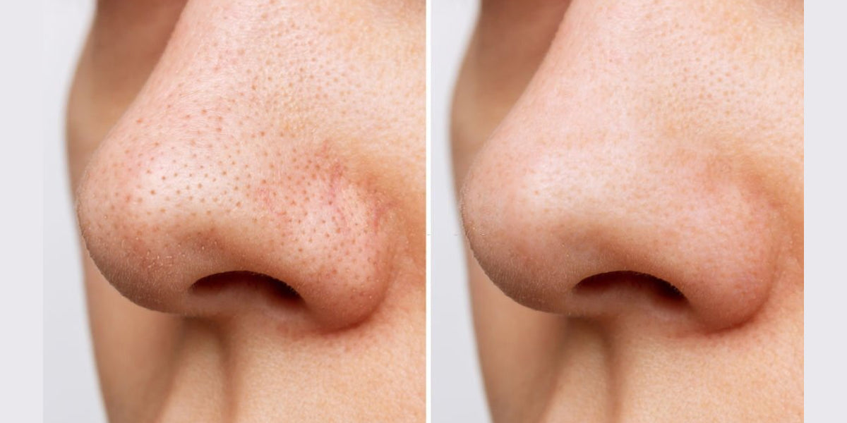 How to reduce pores on the face