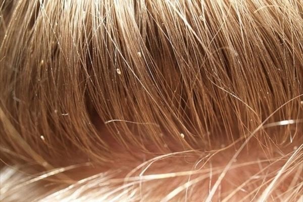 What Do Lice Look Like In Blonde Hair And Ways To Remove Them