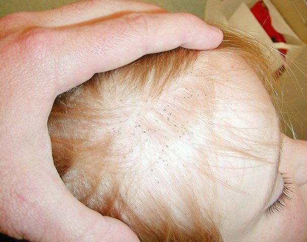 What Do Lice Look Like In Blonde Hair And Ways To Remove Them