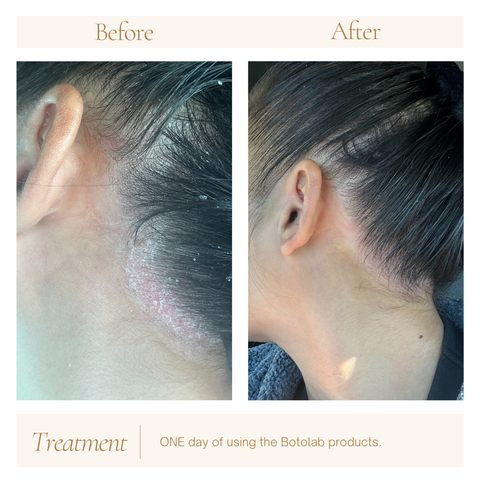 cure for psoriasis. before and after photos