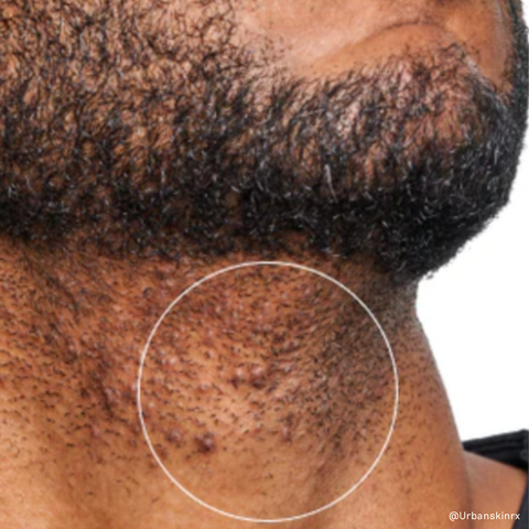 black men's beard with ingrown hairs