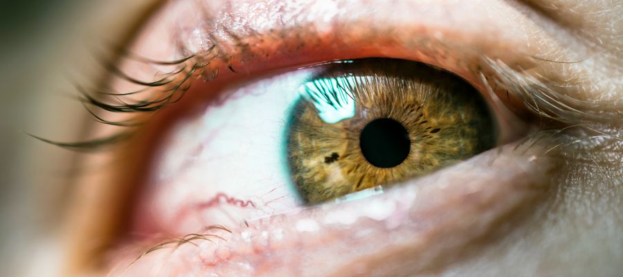 closeup of human eye with redness in the white of the eye