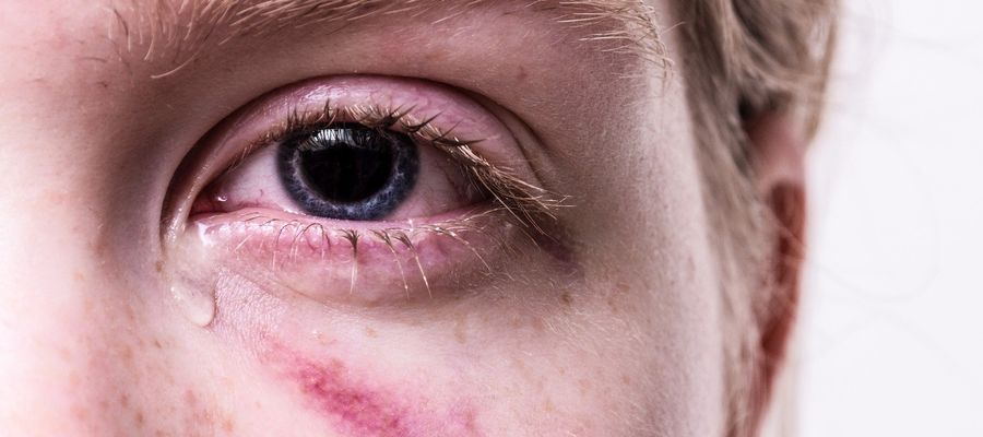 closeup of red injured eye with bruise beneath