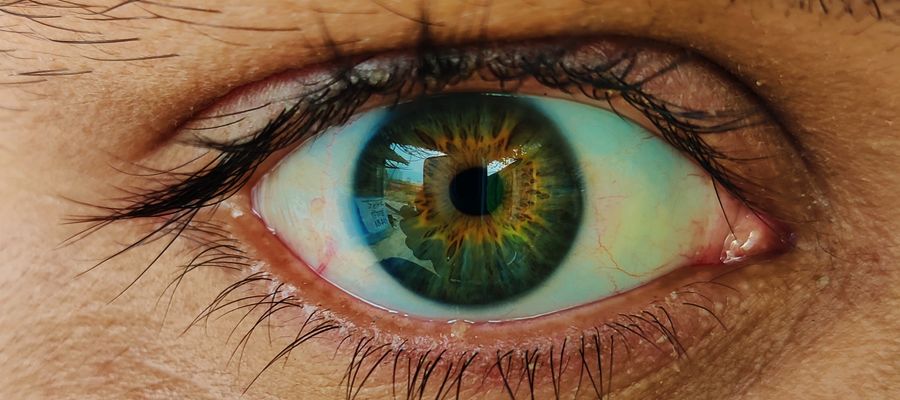 Primer plano del ojo humano con un tinte azul alrededor de la esclerótica.