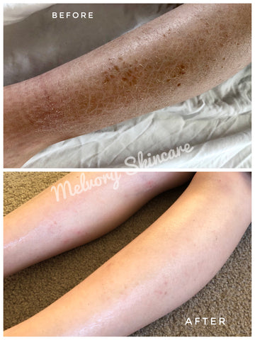 Eczema psoriasis skin rescue itchy skin dry skin scaley skin handmade in Australia Australian made gentle on the skin babies with eczema