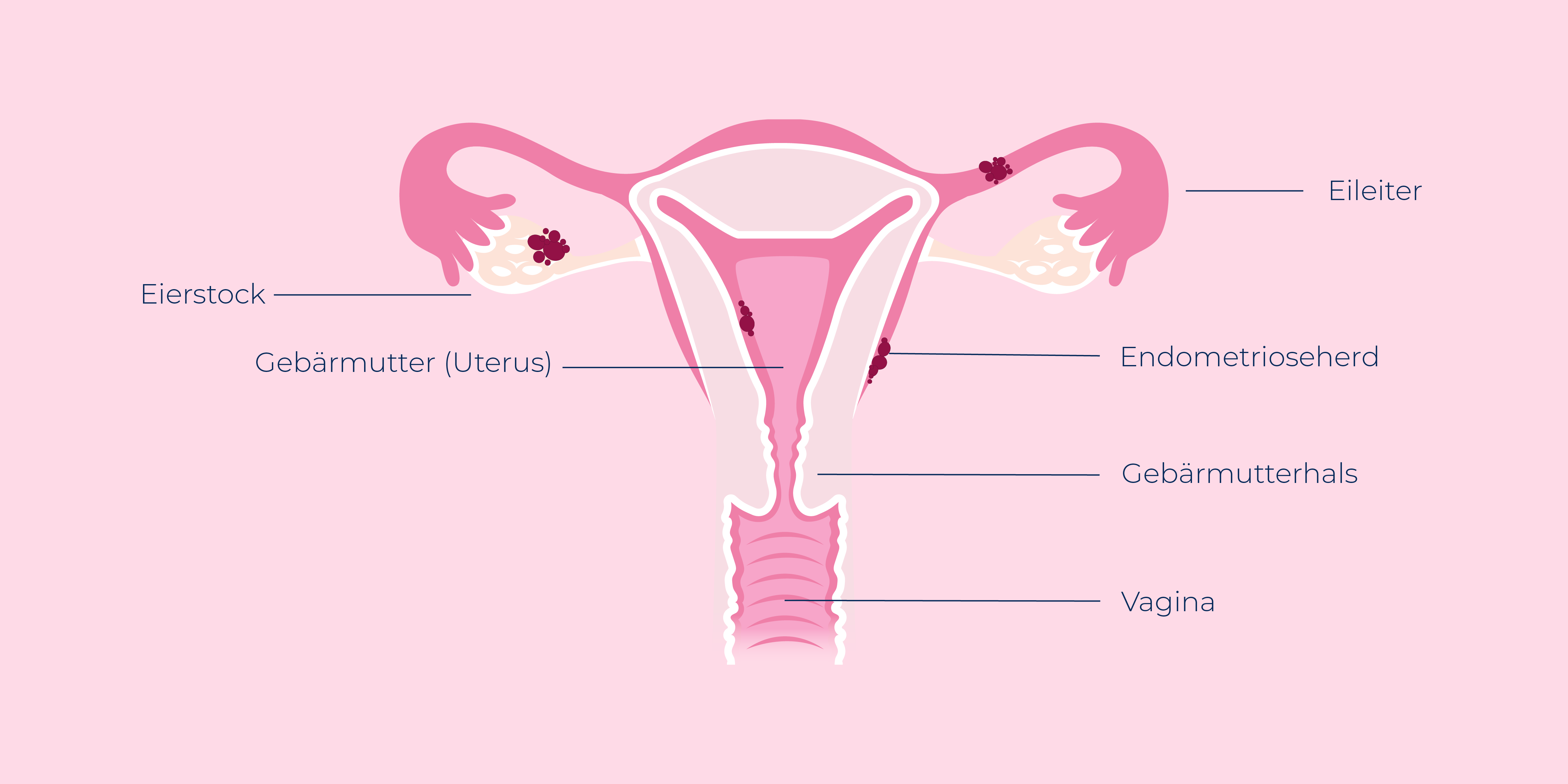 Ovy App Endometriose Endometrioseherde Uterus Gebärmutter Eileiter Eierstock Vagina