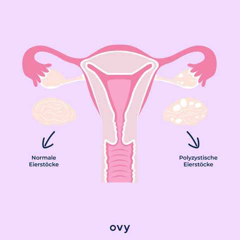 PCO, Polyzystisches Ovarialsyndrom