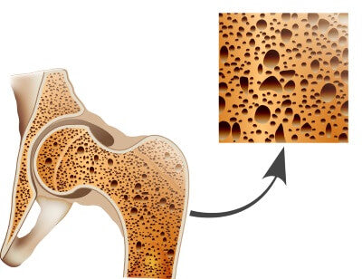 Magnesiummangel und Osteoporose