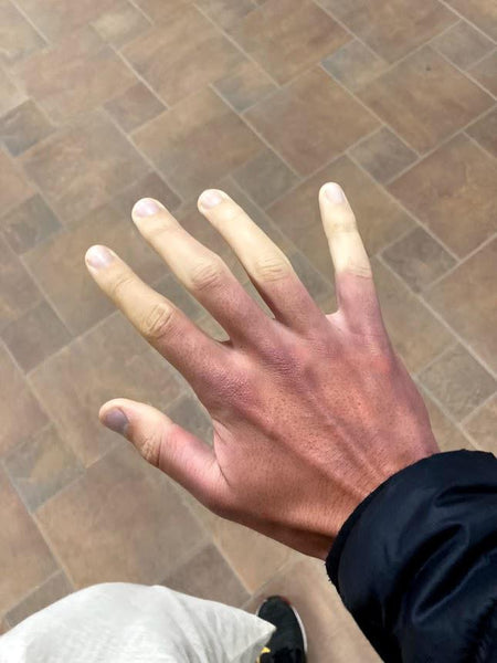 advice for Raynaud's Patient 12
