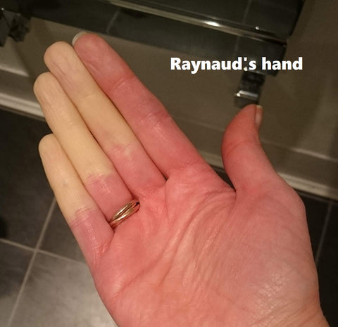 raynaud's hand