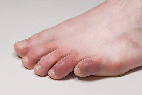 Chilblains