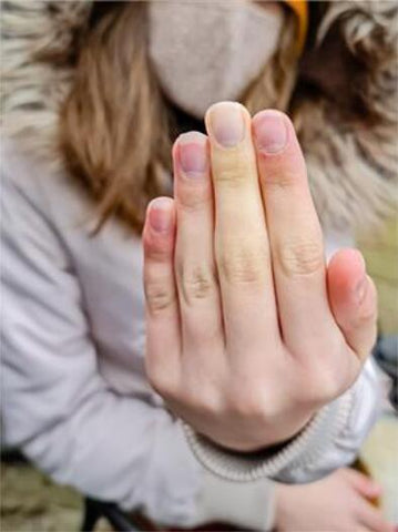advice for Raynaud's Patient 2