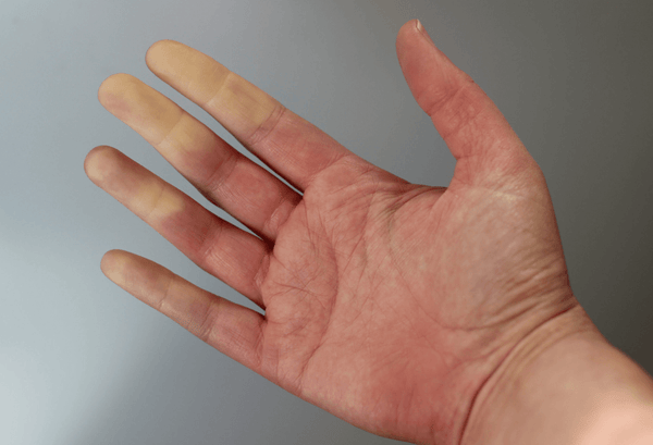 advice for Raynaud's Patient 4