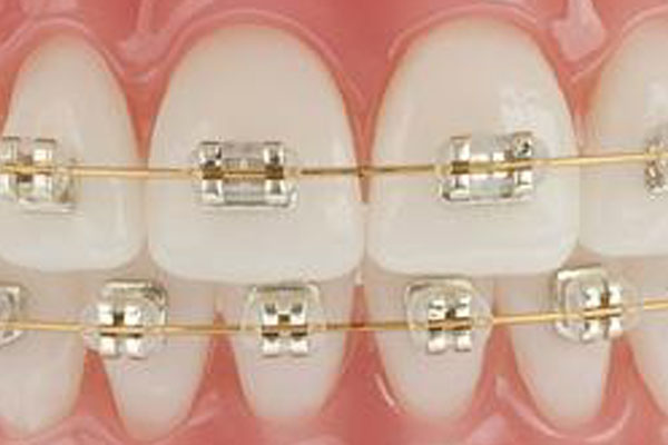 rose gold braces colors wheel