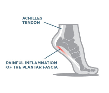An infographic on what plantar fasciitis is and how it affects not only the heel, but the foot