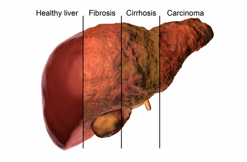 liver-detox-total-body-cleanse-cirrhosis-fibrosis-carcinoma