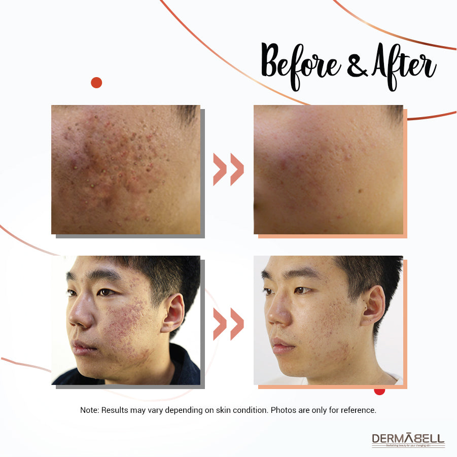 AC Line | Acne-Preventative Skincare | Before and After | Professional & Home-Use | DERMABELL