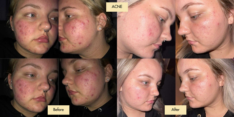 Acne Results from customers using Bangn body Firming lotion 