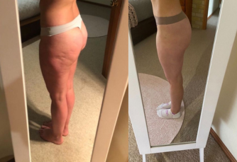 Cellulite before and after