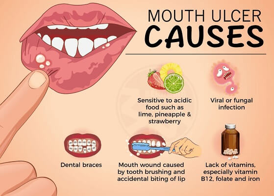 Common Causes of Mouth Ulcers